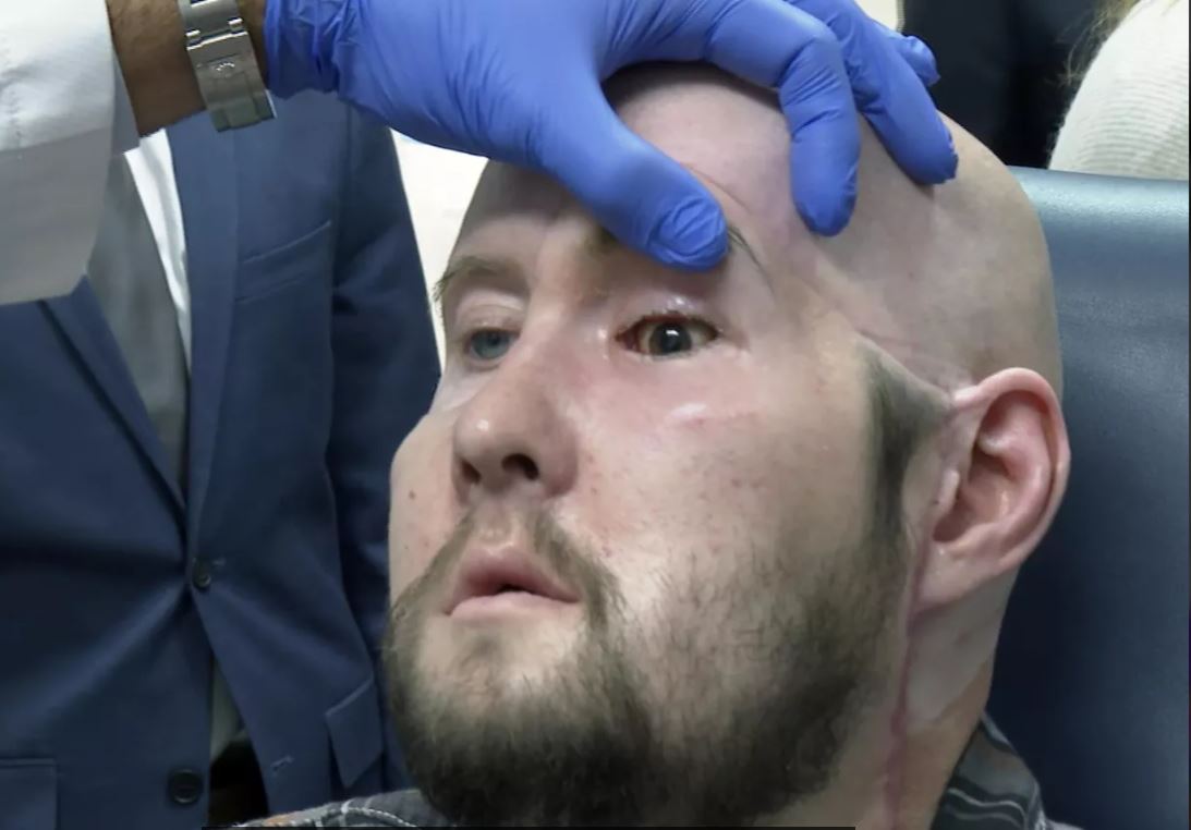 В США провели первую в истории пересадку целого глаза человеку