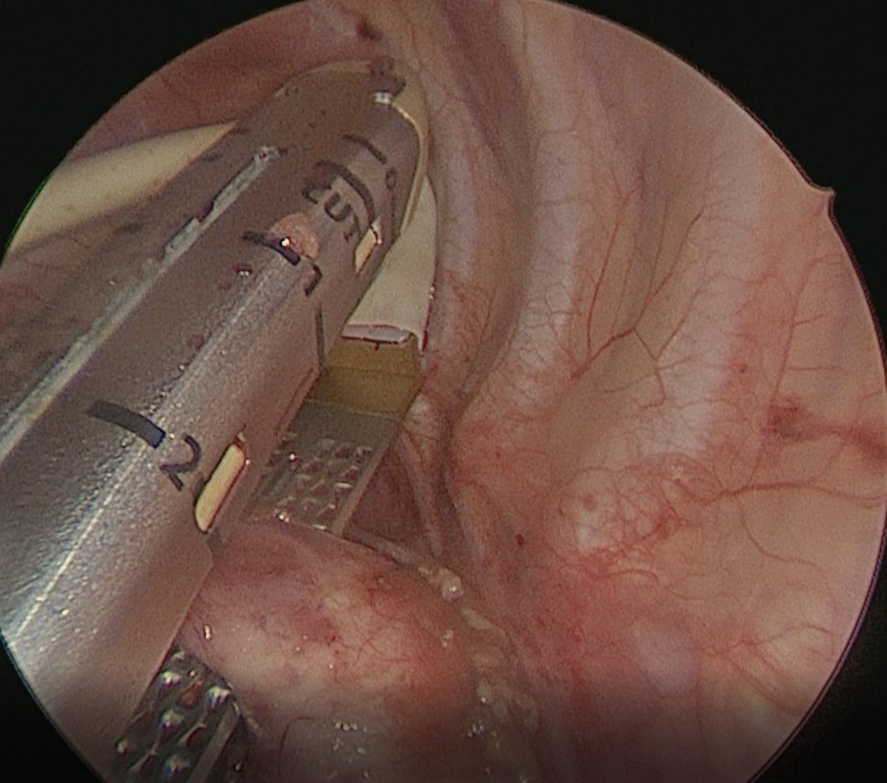 В РНПЦ детской хирургии выполнили уникальную операцию у пациента с двойной дугой аорты